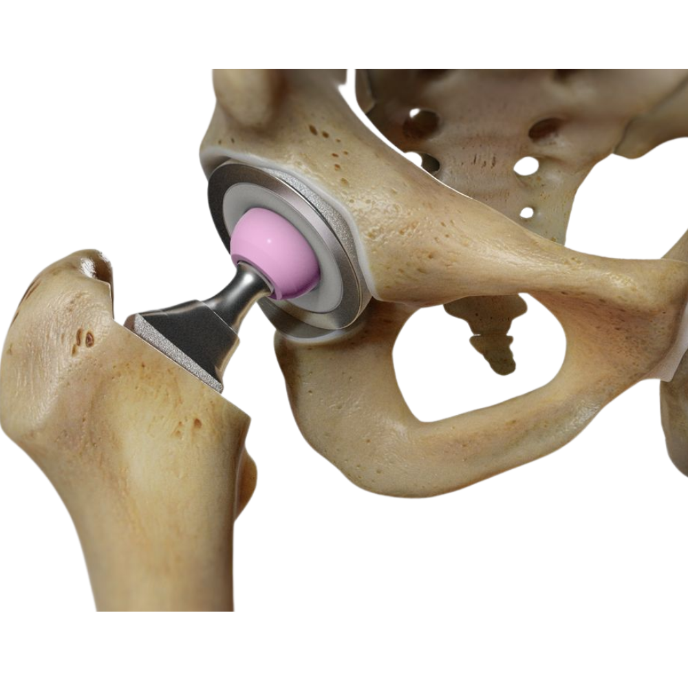 Bilateral Total Hip Replacement
