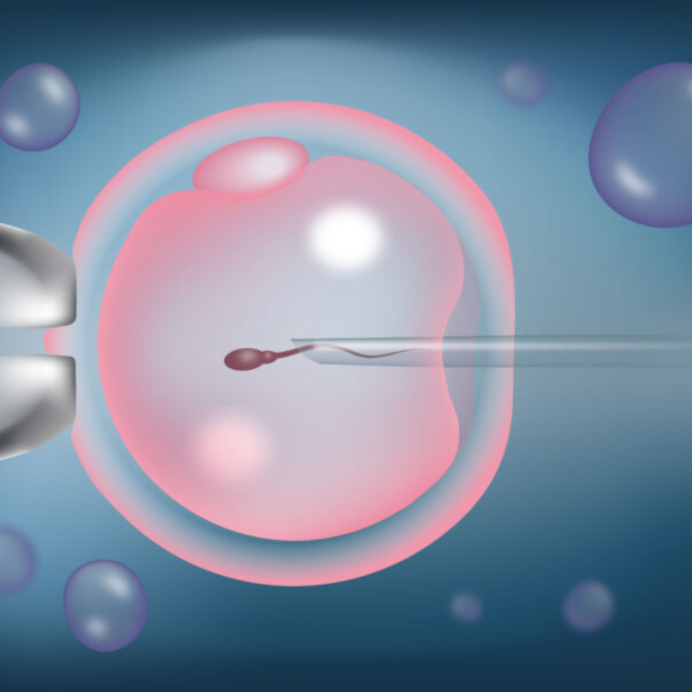 IVF with ICSI (Intracytoplasmic Sperm Injection)