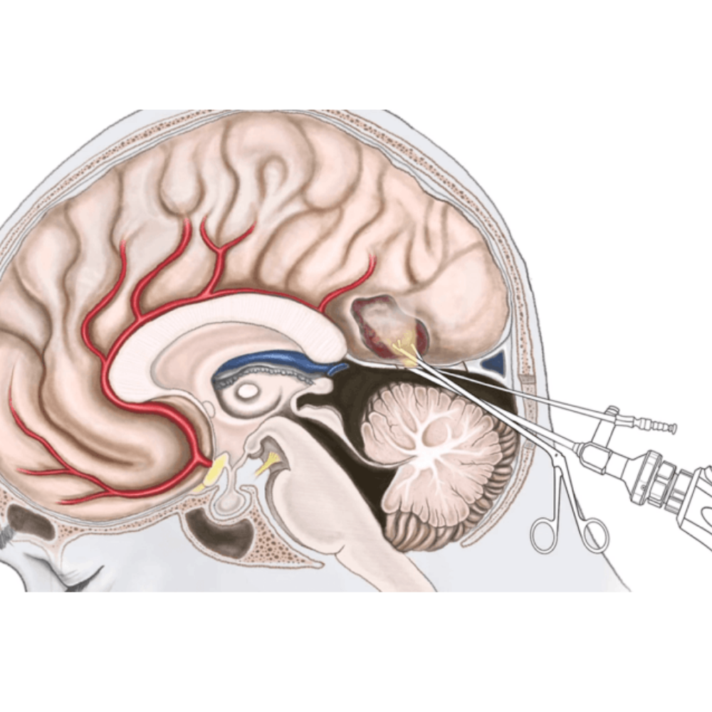 Invasive Methods Brain Methods Brain Tumor - Santhora Health