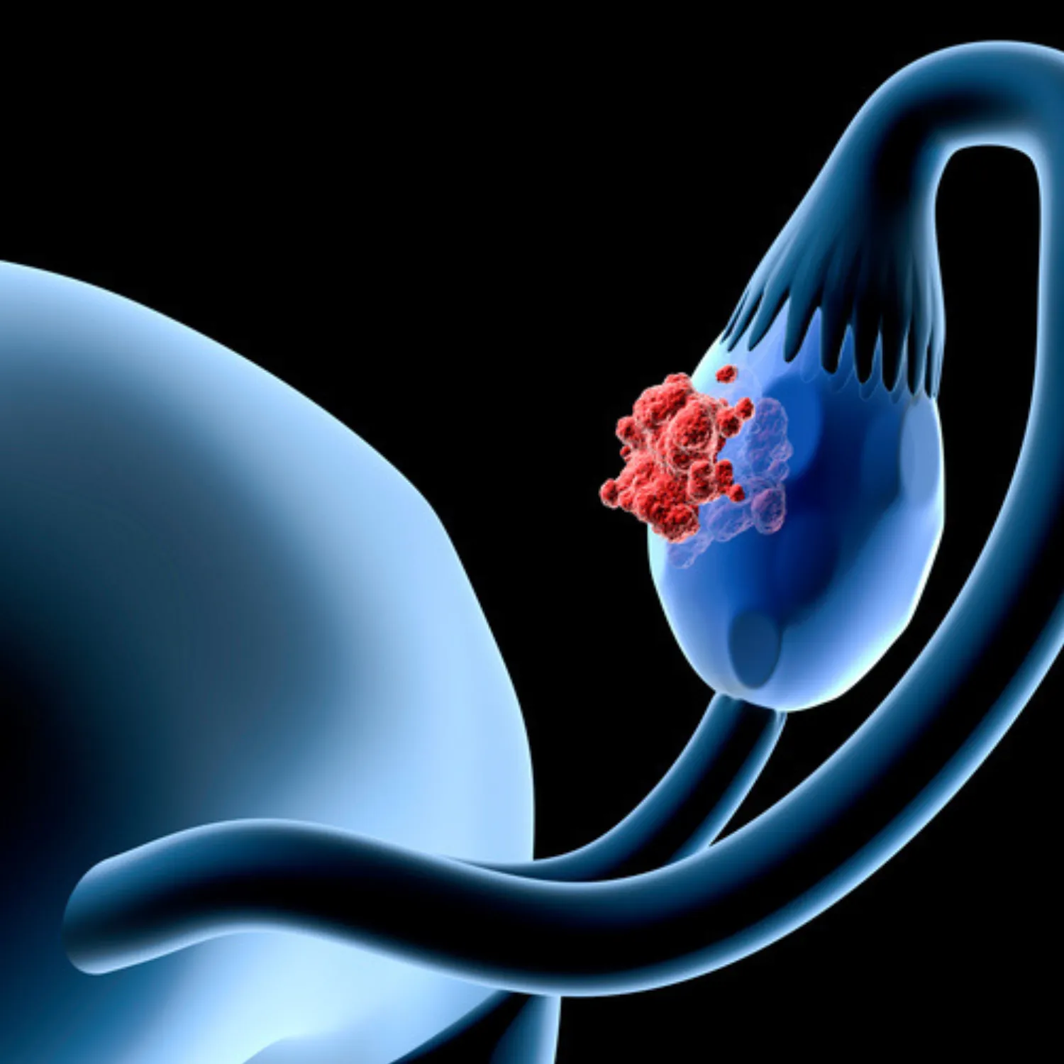 Ovarian Cancer Treatment