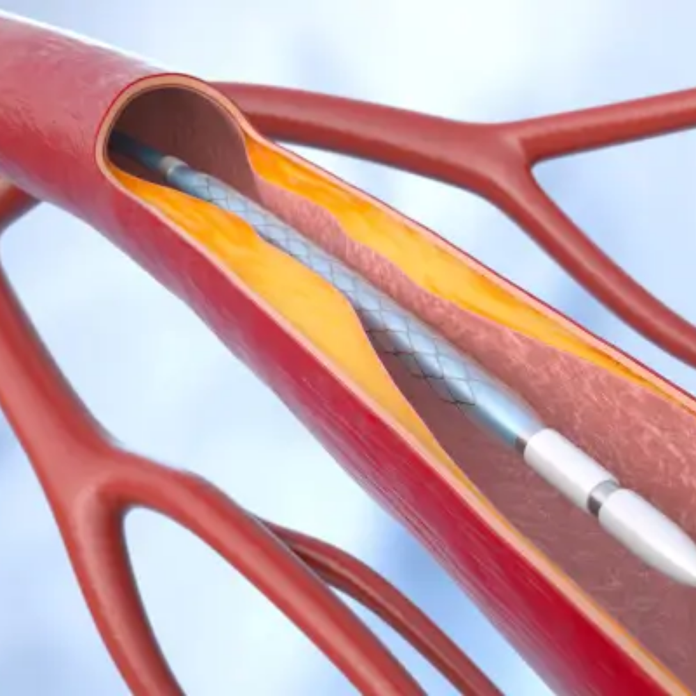 Angioplasty - Santhora Health