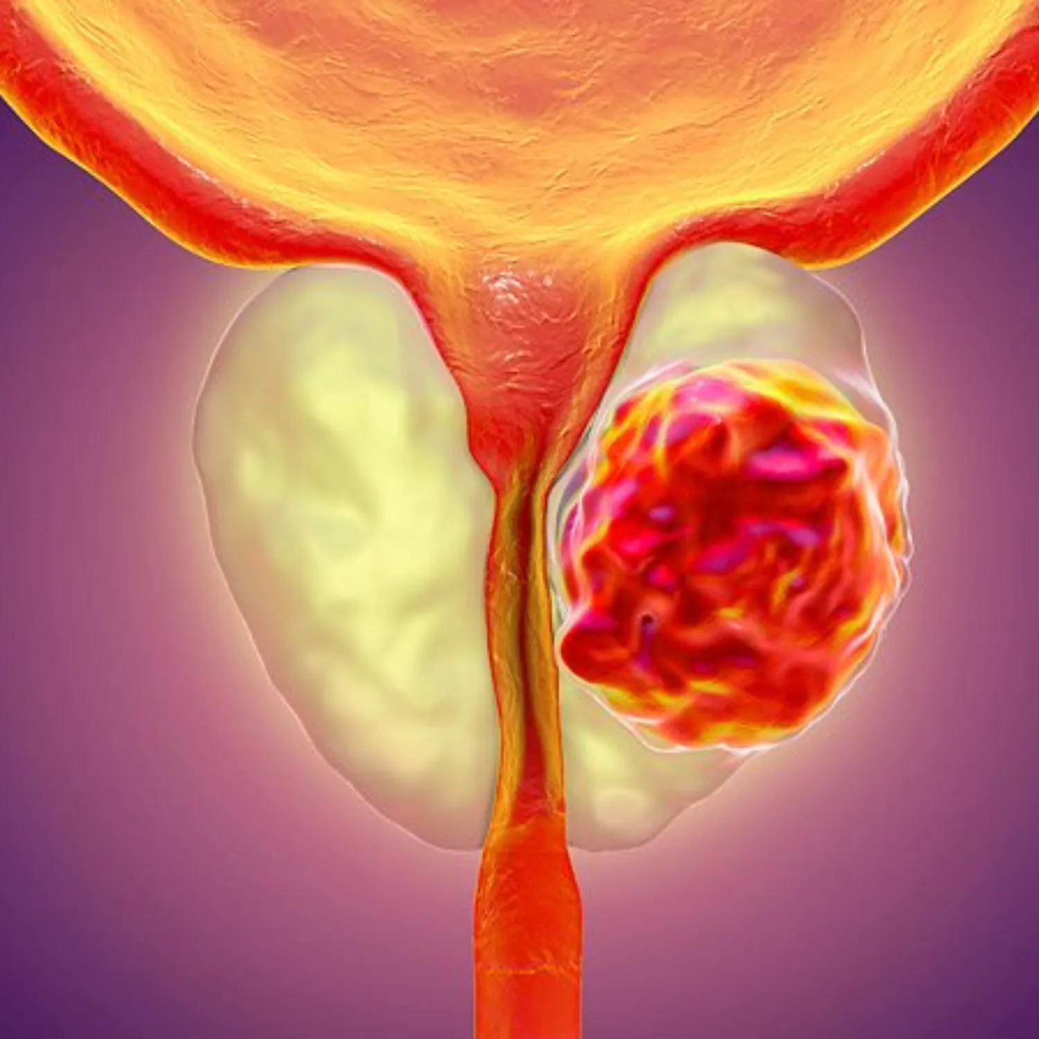 Prostate Cancer Treatment