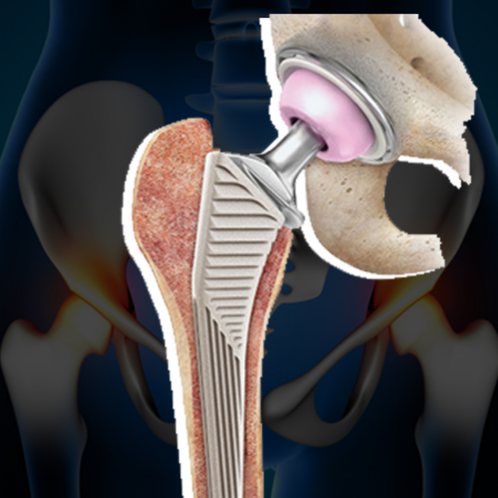 Revision Hip Replacement