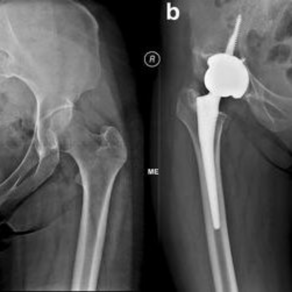 Unilateral (Single) Total Hip Replacement