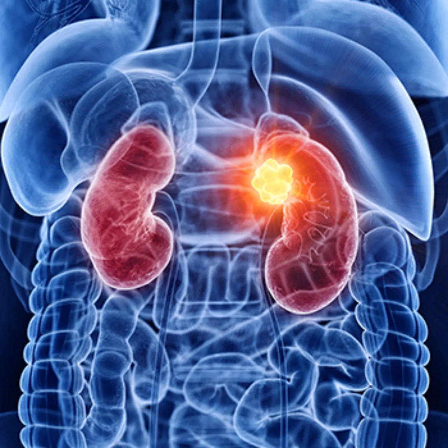 Kidney Cancer Treatment