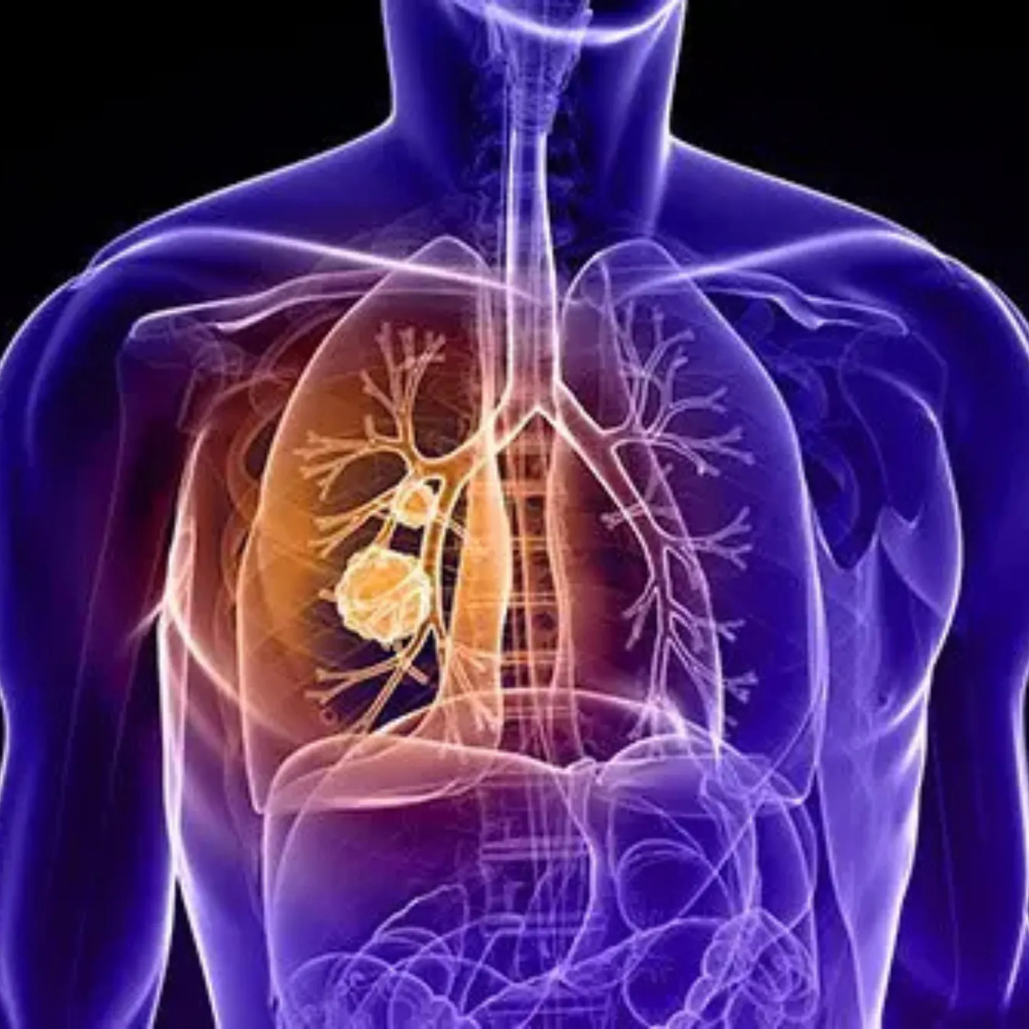 Lung Cancer Treatment