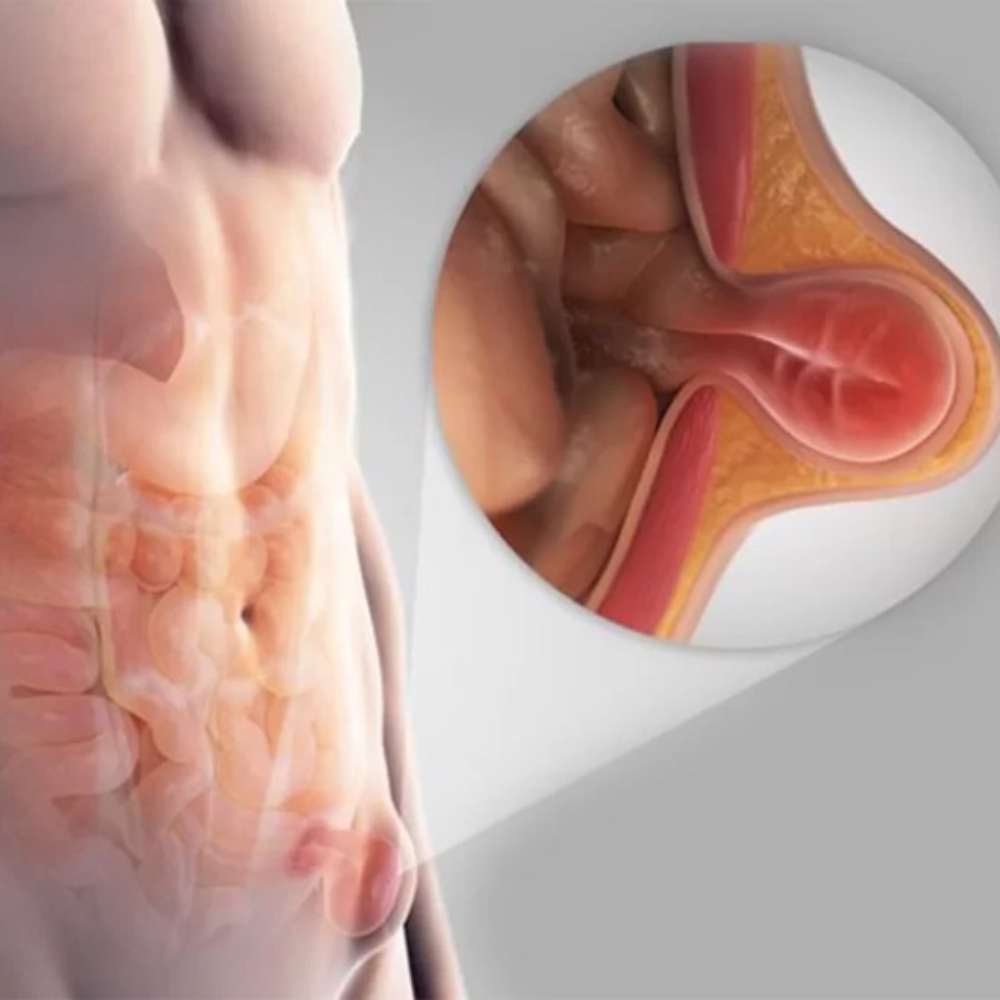 Hernia Repair Surgery