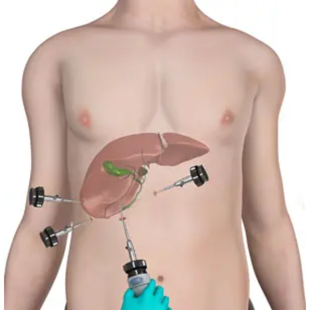 Laparoscopic Gallbladder Surgery (Cholecystectomy