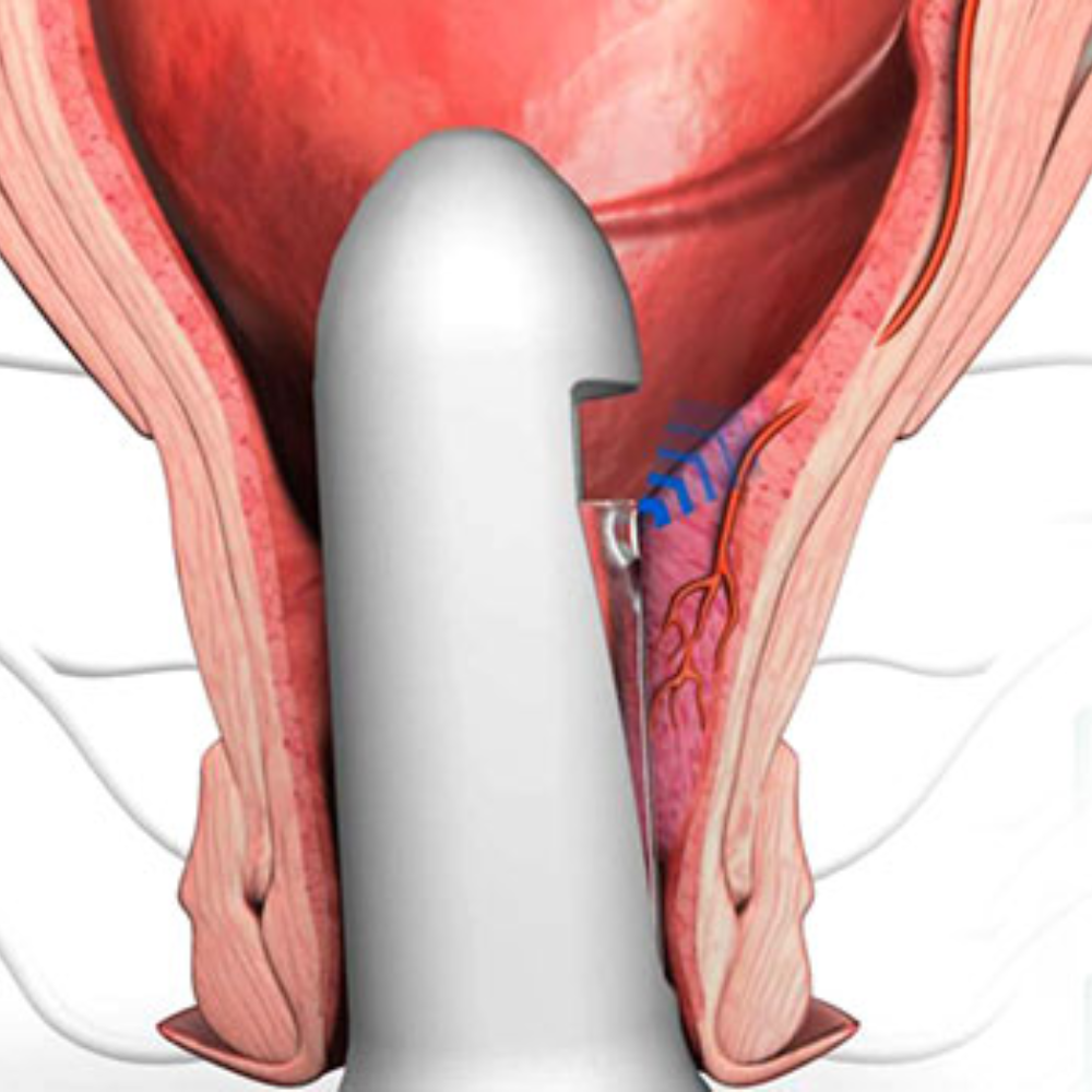 Piles, Fissure & Fistula Surgery