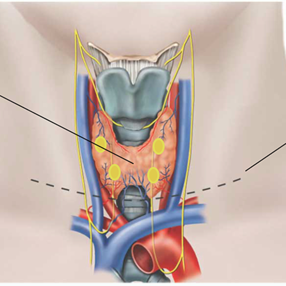 Thyroid Surgery (Thyroidectomy